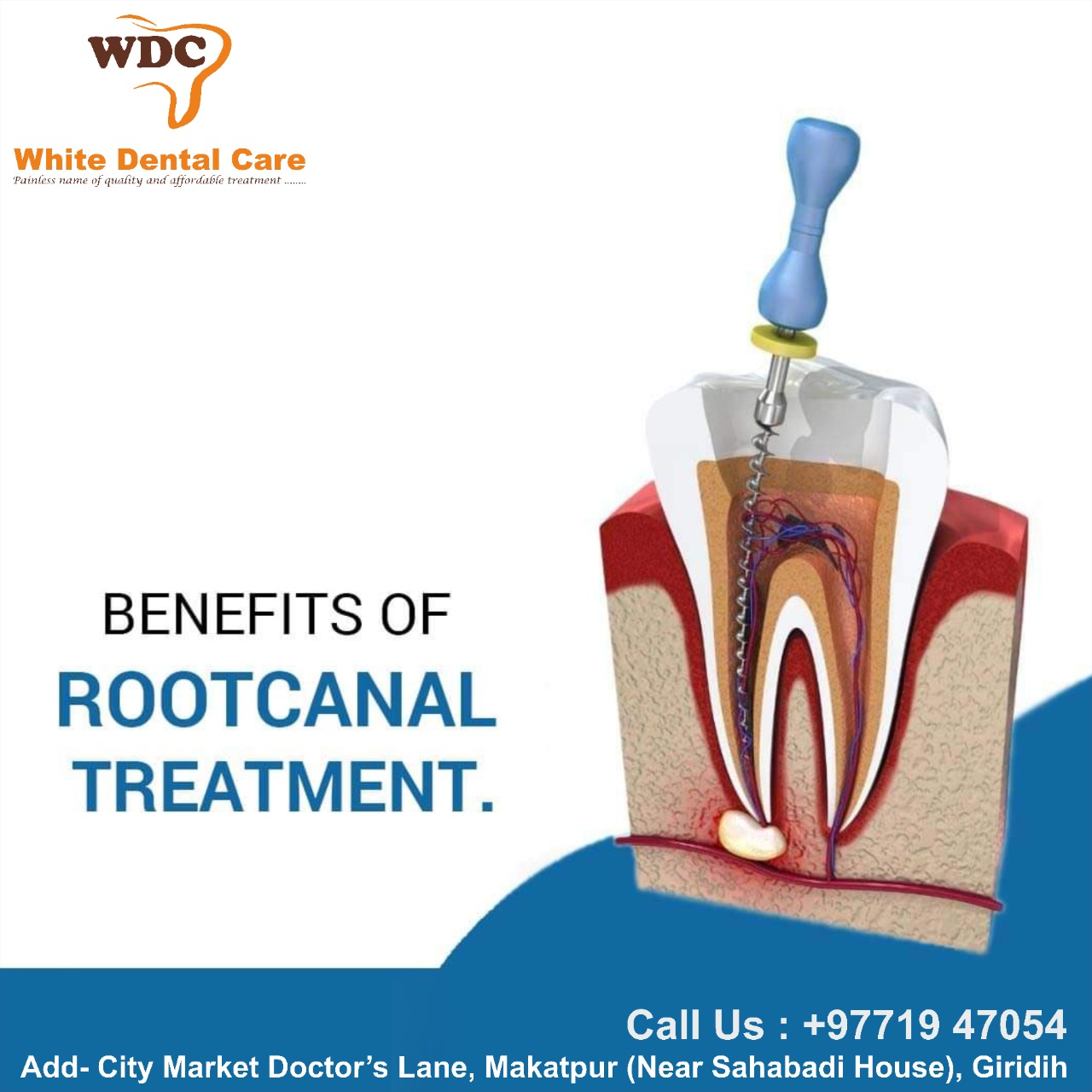Benefits of RCA (Root Canal Treatment)